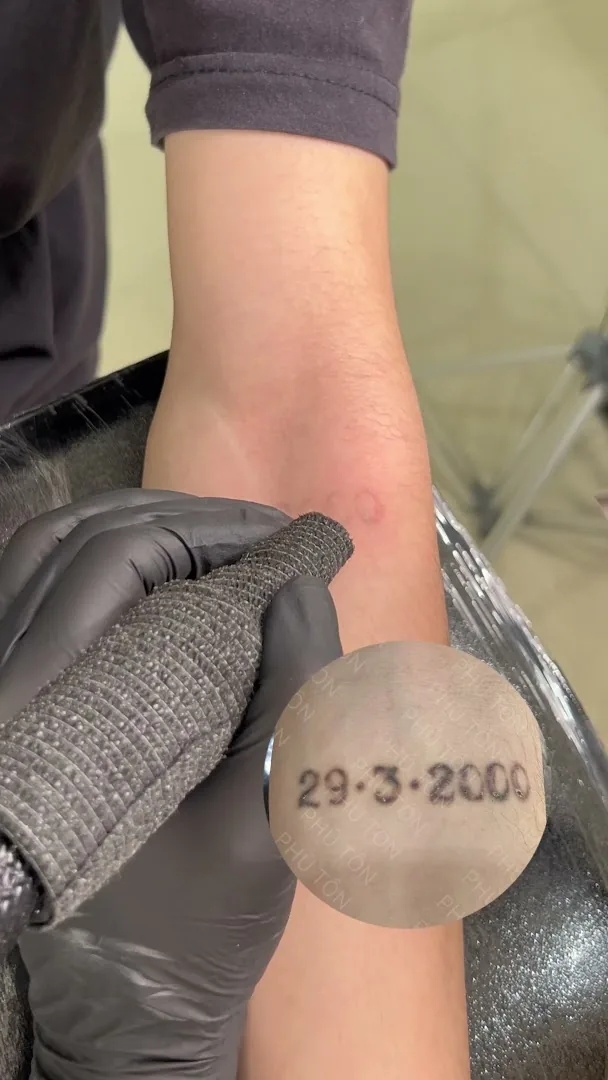 Phú Tôn - Laser Tattoo Removal