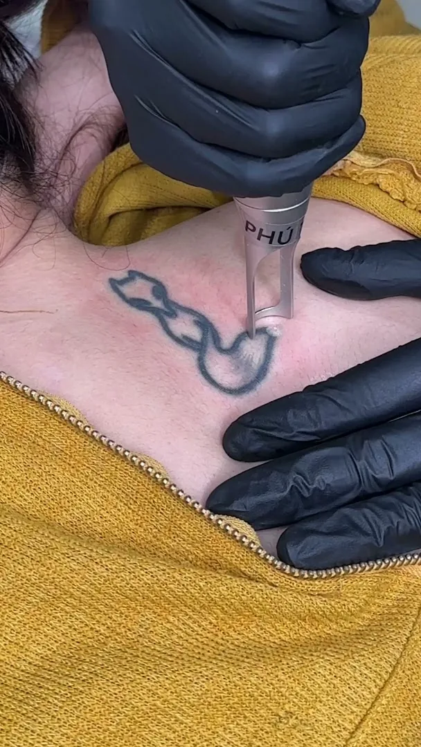 Phú Tôn - Laser Tattoo Removal