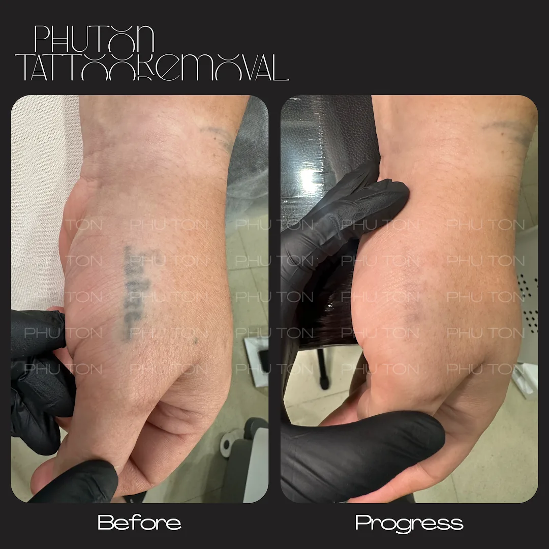 Phú Tôn - Laser Tattoo Removal