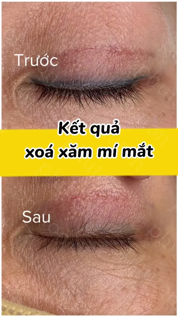 Phú Tôn - Laser Tattoo Removal