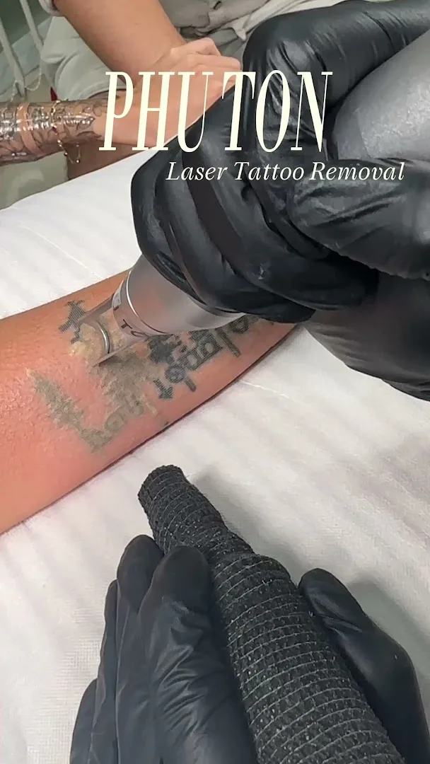 Phú Tôn - Laser Tattoo Removal