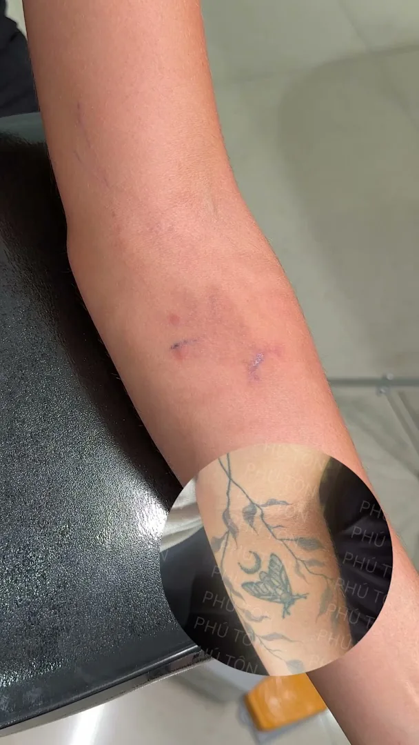 Phú Tôn - Laser Tattoo Removal