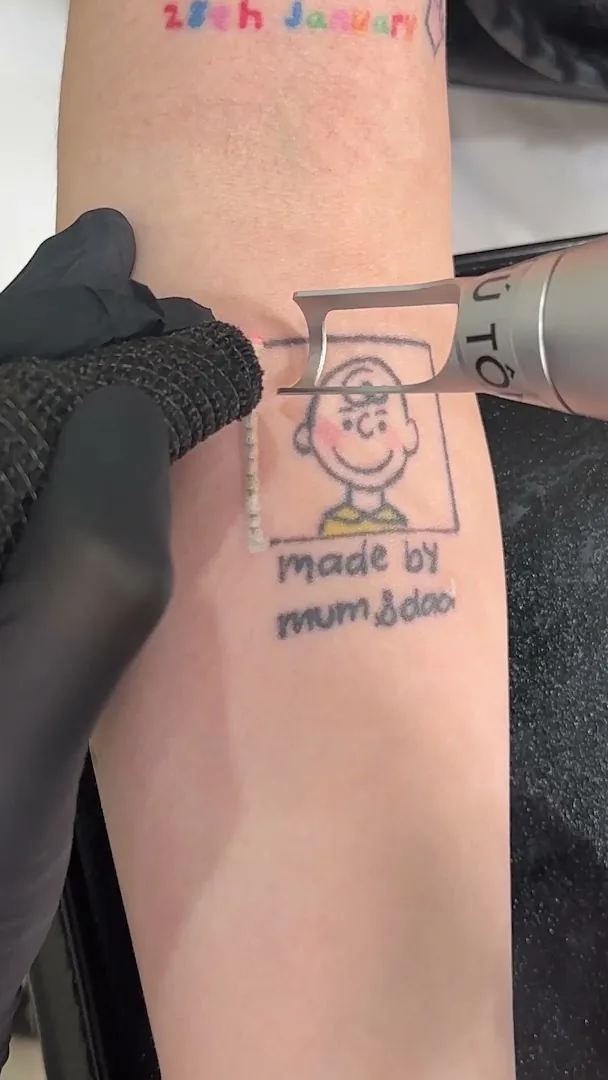 Phú Tôn - Laser Tattoo Removal