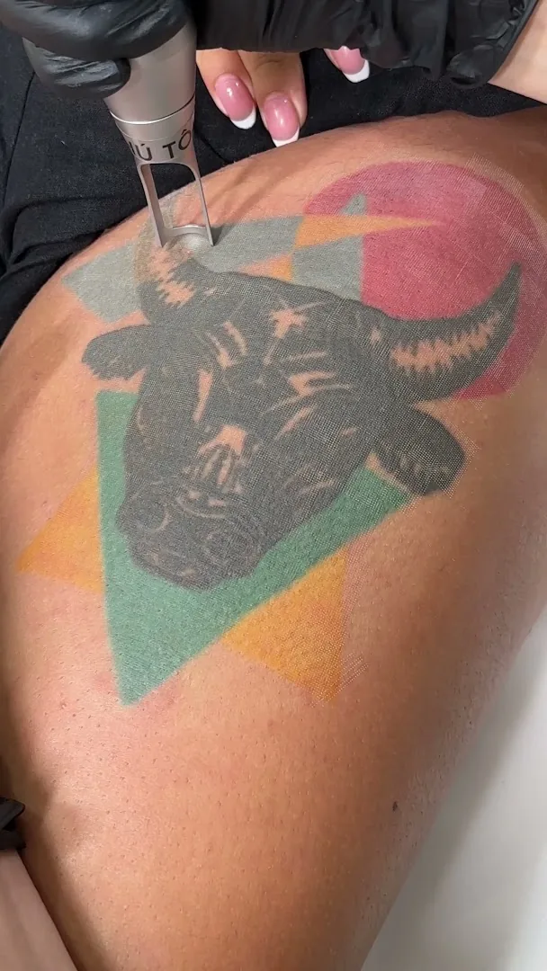 Phú Tôn - Laser Tattoo Removal