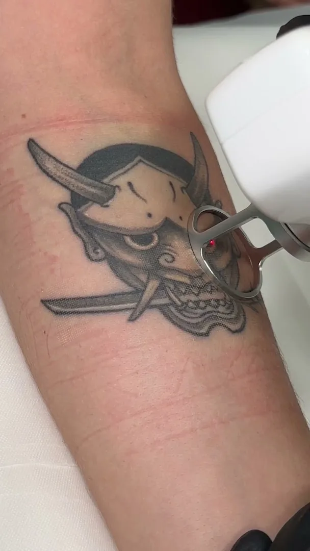 Phú Tôn - Laser Tattoo Removal