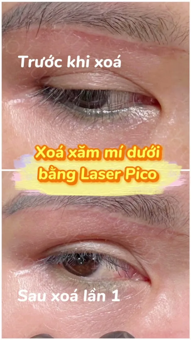 Phú Tôn - Laser Tattoo Removal